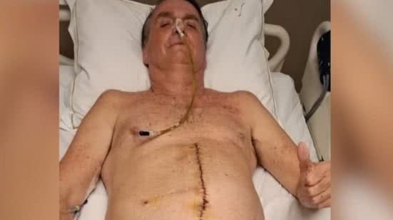 Imagem publicada por Bolsonaro revela estado das alças intestinais após cirurgia para tratar complicações de facada em 2018. - Divulgação