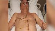 Imagem publicada por Bolsonaro revela estado das alças intestinais após cirurgia para tratar complicações de facada em 2018. - Divulgação