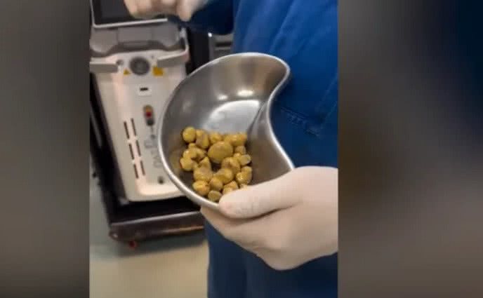 Pedras na bexiga podem causar dor ao urinar e outros sintomas; a prevenção inclui a ingestão adequada de líquidos e tratamento da hiperplasia prostática. - Divulgação