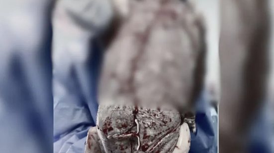 O nascimento de Bernardo gerou curiosidade ao mostrar o DIU da mãe colado ao seu corpo logo após o parto, viralizando nas redes sociais. - Divulgação
