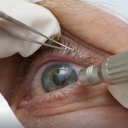 Cirurgia estética nos olhos viraliza, mas pode custar a visão - Reprodução
