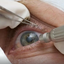 Cirurgia estética nos olhos viraliza, mas pode custar a visão - Reprodução