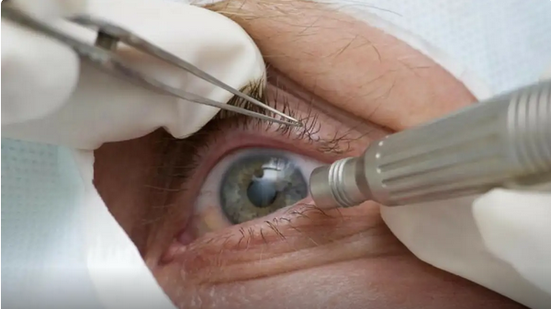 Cirurgia estética nos olhos viraliza, mas pode custar a visão - Reprodução