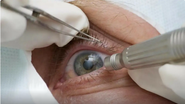 Cirurgia estética nos olhos viraliza, mas pode custar a visão - Reprodução