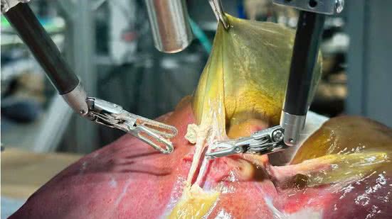 Robô realiza operação delicada sozinho e redefine os limites da medicina - Reprodução