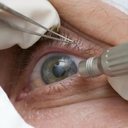 A técnica é indicada apenas em casos específicos e deve ser realizada por profissionais qualificados - Reprodução/Prefeitura de Três Barras SC/Agência Brasil