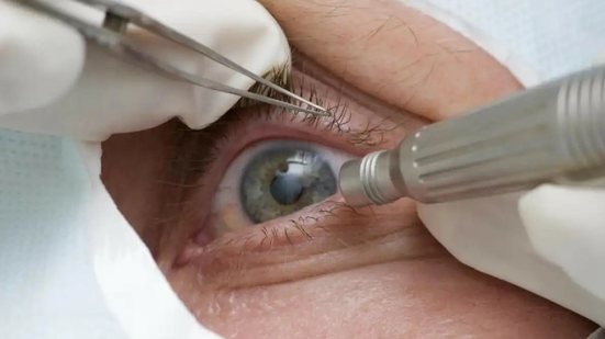 A técnica é indicada apenas em casos específicos e deve ser realizada por profissionais qualificados - Reprodução/Prefeitura de Três Barras SC/Agência Brasil