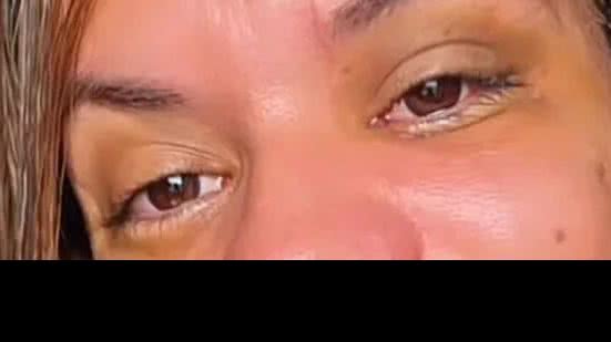 Juliana Soares compartilha sua jornada de recuperação 30 dias após cirurgia de reconstrução facial após ataque violento. - Divulgação