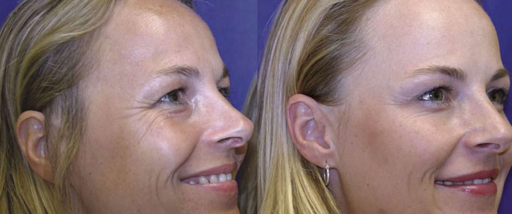 botox