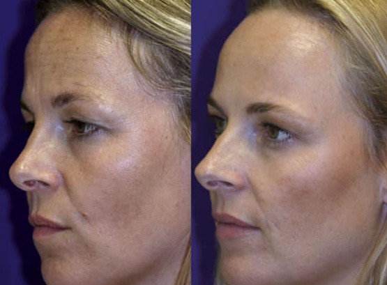 gemeas botox