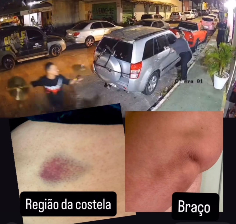 As imagens divulgadas pela própria cantora mostram os hematomas deixados pela agressão. Imagem: reprodução redes sociais.